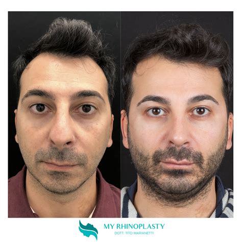 Rinoplastica Punta Naso Scopri L Intervento My Rhinoplasty