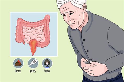 直肠炎 有来医生