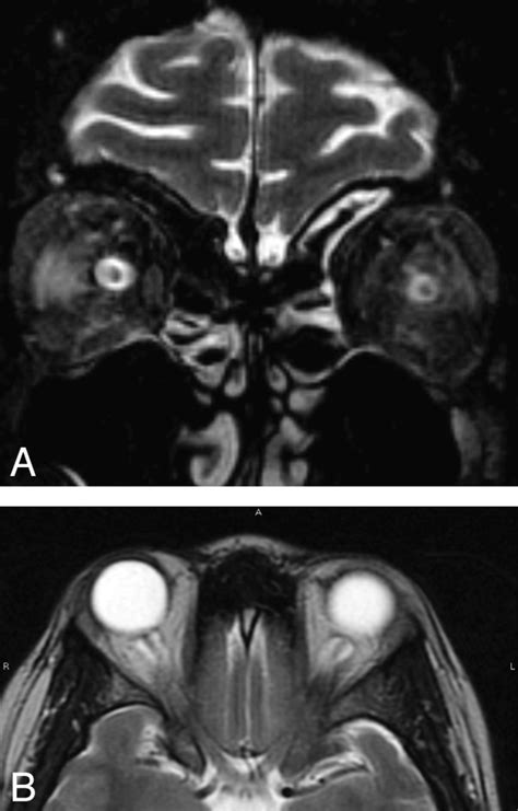 Mr Imaging Of Papilledema And Visual Pathways Effects Of Increased