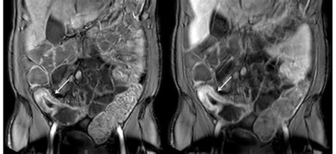 Magnetic Resonance Imaging Of The Abdominal Cavity Indications