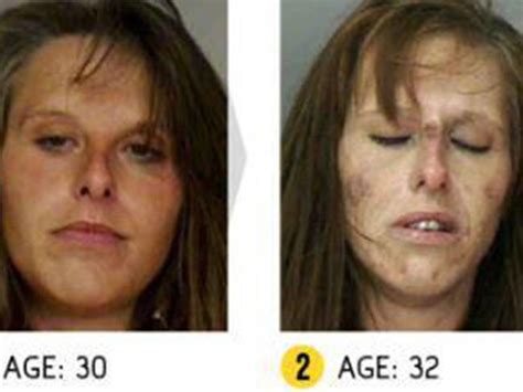 Drug Addiction Before And After Photos Show Shocking Reality Of Addicts Au