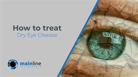 How To Treat Dry Eye Disease News Mainline Instruments