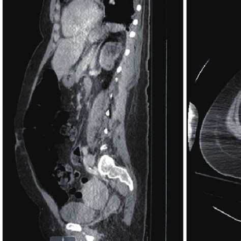 Ct Abdomen Pelvis With Contrast Coronal Sagittal And Axial Views