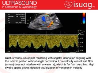 Isuog Practice Guidelines Use Of Doppler Ultrasonography In Obstetrics