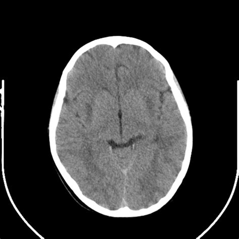 Initial CT scan showing bilateral symmetric hypodensities of the... | Download Scientific Diagram