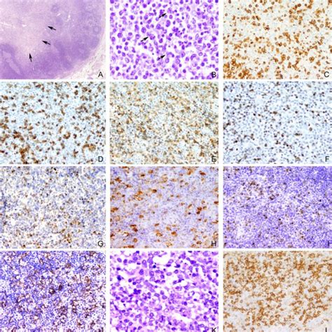 CD30-positive atypical cells in case 1. Case 1 showed... | Download ...