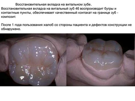 Культевые штифтовые вкладки Pentron под металлокерамику - презентация ...