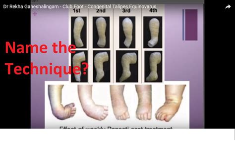 Basics Of Clubfoot —