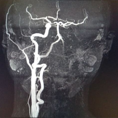 Magnetic Resonance Angiogram Of A Patient With Takayasu Arteritis