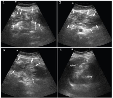 Ruptured Splenic Artery Aneurysm: Rare Cause of Shock Diagnosed with ...