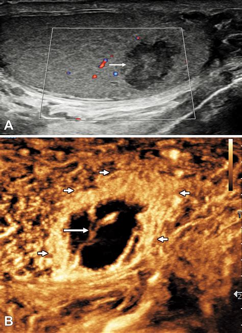 Contrast Enhanced Us Of Segmental Testicular Infarction Radiology