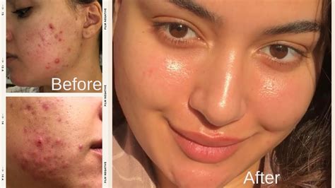 Acne Prone Updated Skincare Routine Post Inflammatory