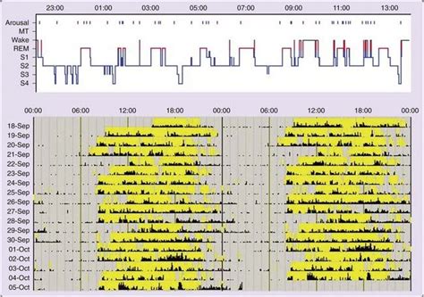 Idiopathic Hypersomnia | Neupsy Key