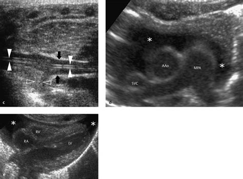 6 Mediastinum Radiology Key