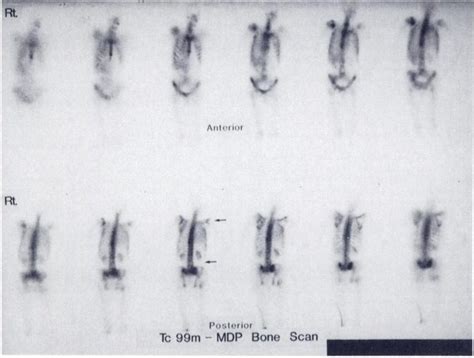 Bone Tomoscan Reveals Abnormal Foci In Right Shoulder Anterior Ribs