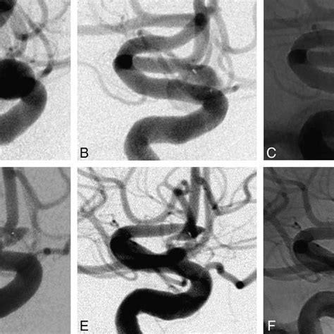 Pdf One Year Angiographic Follow Up After Web Sl Endovascular