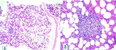 Trabajos de Hematología y Hemoterapia Anemia hemolítica autoinmune por