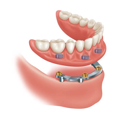 QSIP - Zest Anchors Locator Abutments