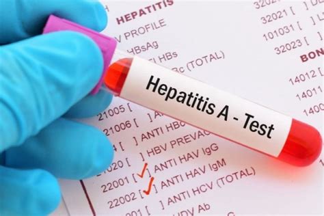 Hepatit A nedir Hepatit A tedavisi nasıl yapılır Sağlık ve Beslenme