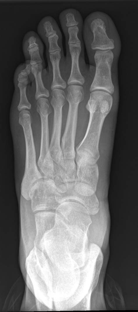 The Patterns Of Injury And Management Of Cuboid Fractures Bone Joint