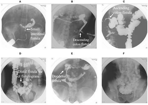 Frontiers Nutritional Management Of Patients With Enterocutaneous