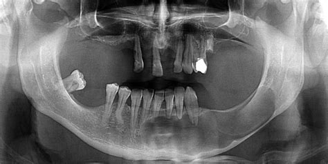 Keratocystic Odontogenic Tumor