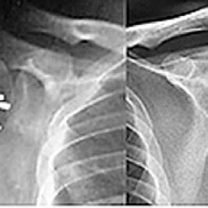 Post Operative AP Radiograph Of Both Shoulders Showing Greater