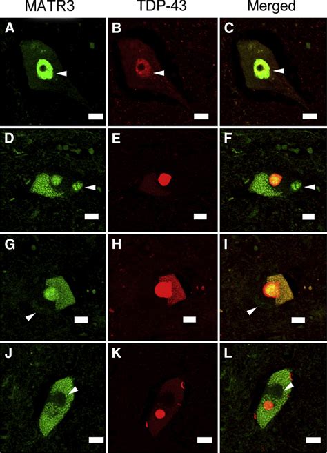 Matrin Is A Component Of Neuronal Cytoplasmic Inclusions Of Motor