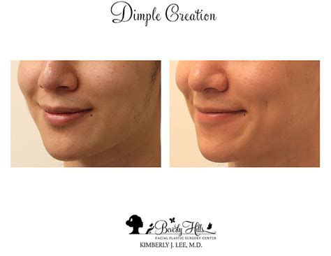 Dimple Creation Before & After Photos | Dr. Kimberly Lee