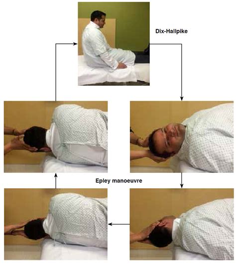 RACGP - Semont manoeuvre for vertigo assessment