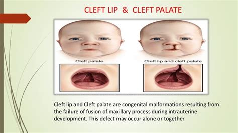 Cleft Lip And Palate Ppt Free Download