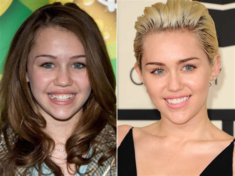 Miley Cyrus Plastic Surgery Before And After Celebrity Plastic Surgery