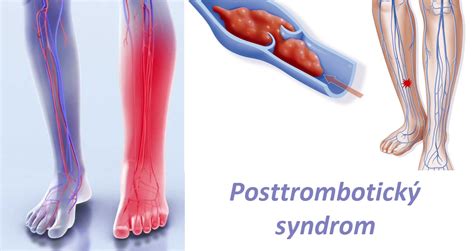 Posttrombotický Syndrom Příznaky Projevy Symptomy Příčina Léčba