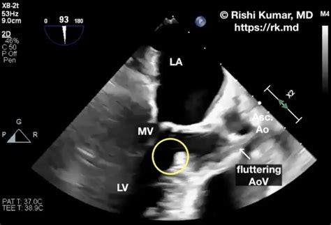 Subaortic Membrane Rk Md