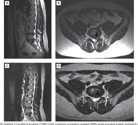 Figure 2 From Spontaneous Regression Of Lumbar Herniated Disc