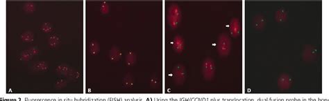 Figure 1 From Blastoid Variant Mantle Cell Lymphoma With Amplified Igh Ccnd1 Fusion A Unique