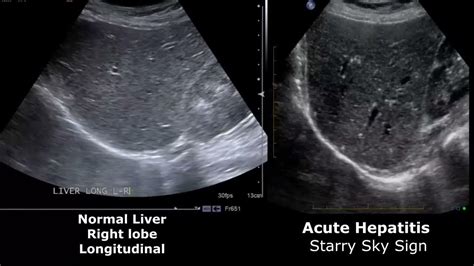 Normal Vs Fatty Liver Ultrasound