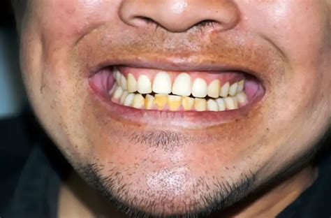 Why Do Old Teeth Turn Yellow Causes And Further Prevention