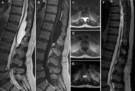 Preoperative And Postoperative Magnetic Resonance Imaging Preoperative Download Scientific