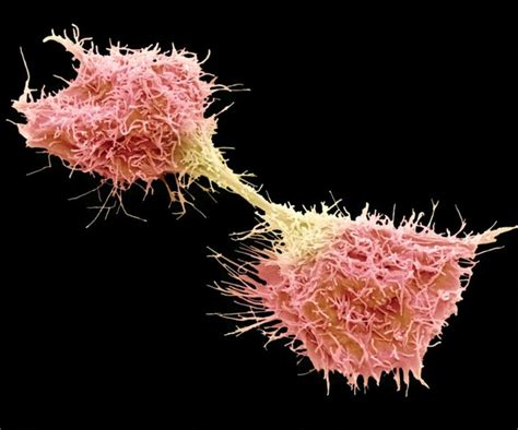 Why are Cancer Cells "Immortal" | Ramsey, NJ Patch