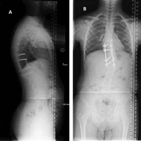 A B Scoliosis X Ray A Anteroposterior Ap And B Lateral 4 Months