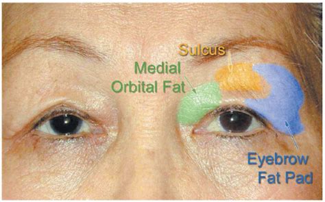 Blepharoplasty Special Considerations In The Asian Eyelid Plastic