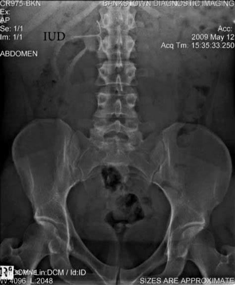 Abdominal X Ray Of Patient Showing Intrauterine Device Lodged In The