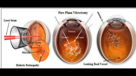 Vitrectomy For Floaters Recovery Day 5 Other People S Vlogs