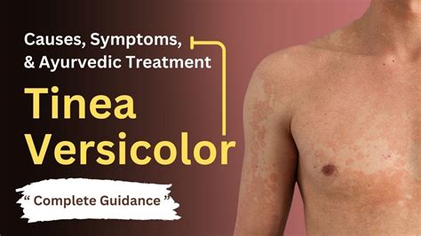 Salicylic Acid To Treat Tinea Versicolor At Matilda Chomley Blog