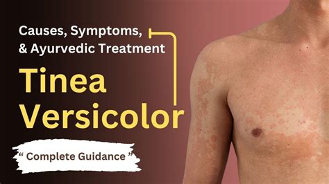 Tinea Versicolor Healing Stages Pictures And Treatment 48 OFF