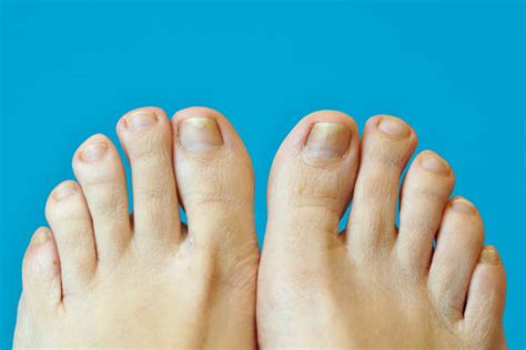 Psoriasis In Toenails Stock Photos, Pictures & Royalty-Free Images - iStock