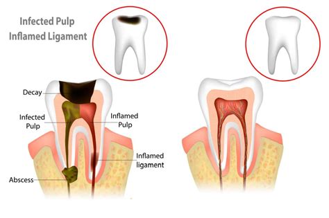 Root Canal Treatment Creekside Premier Dental Tooth Restoration