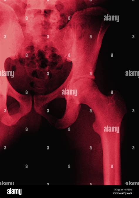 Normal Hip X Ray Hi Res Stock Photography And Images Alamy