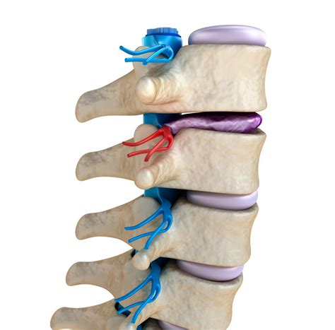 Degenerative disc disease: Causes and treatment